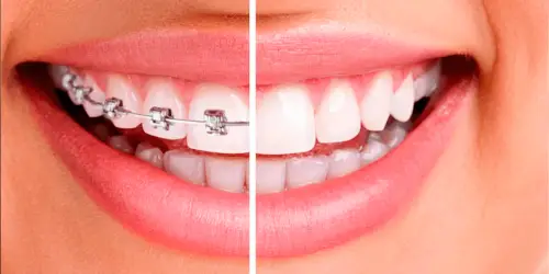 Healthy-white-smile-close-up.-Beauty-woman-with-perfect-smile-lips-and-teeth 1